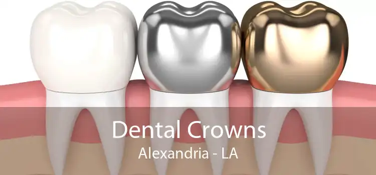 Dental Crowns Alexandria - LA