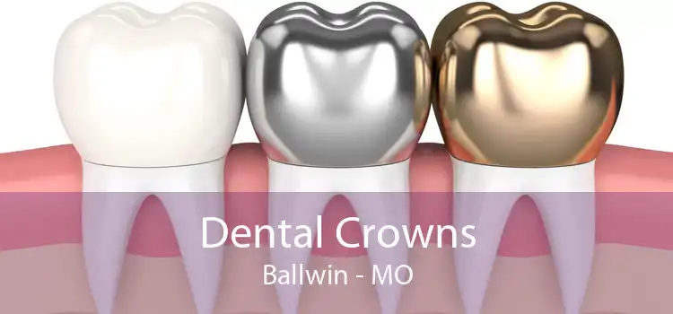 Dental Crowns Ballwin - MO