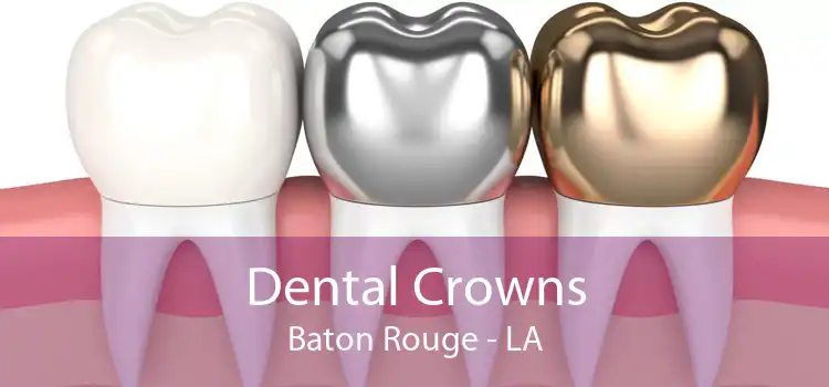 Dental Crowns Baton Rouge - LA