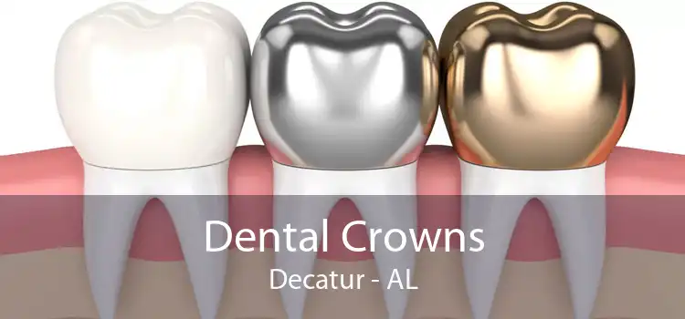 Dental Crowns Decatur - AL