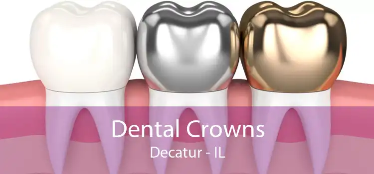 Dental Crowns Decatur - IL