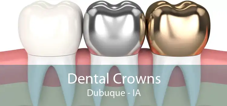 Dental Crowns Dubuque - IA