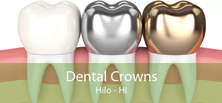 Dental Crowns Hilo - HI