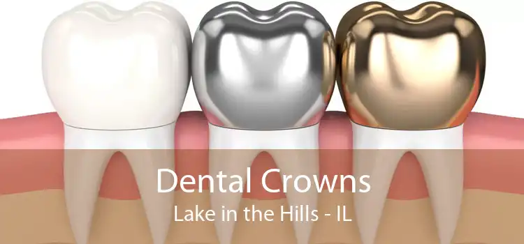 Dental Crowns Lake in the Hills - IL
