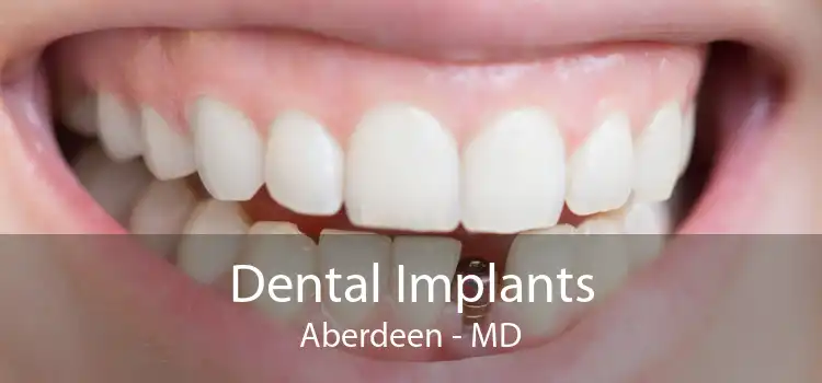 Dental Implants Aberdeen - MD