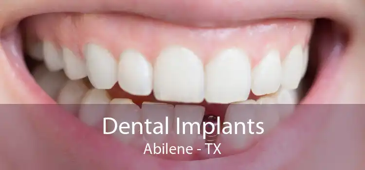 Dental Implants Abilene - TX