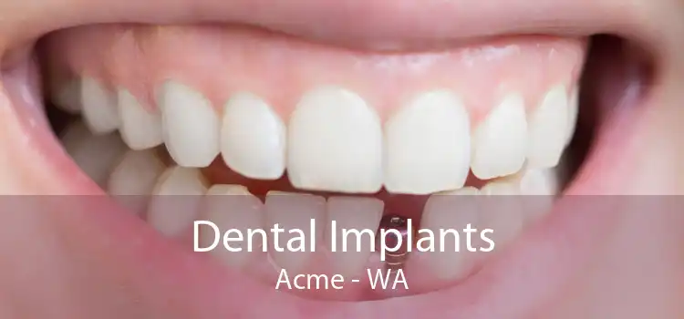 Dental Implants Acme - WA