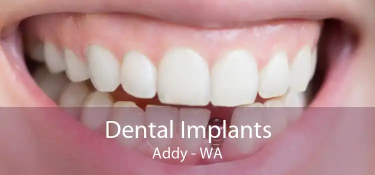Dental Implants Addy - WA