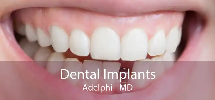 Dental Implants Adelphi - MD