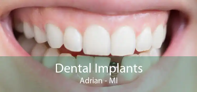Dental Implants Adrian - MI