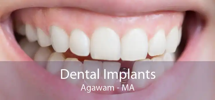 Dental Implants Agawam - MA