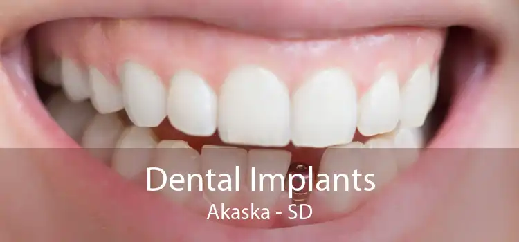Dental Implants Akaska - SD