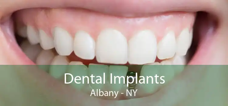 Dental Implants Albany - NY
