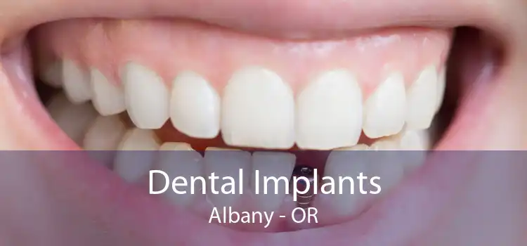 Dental Implants Albany - OR
