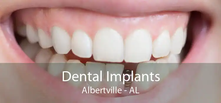 Dental Implants Albertville - AL