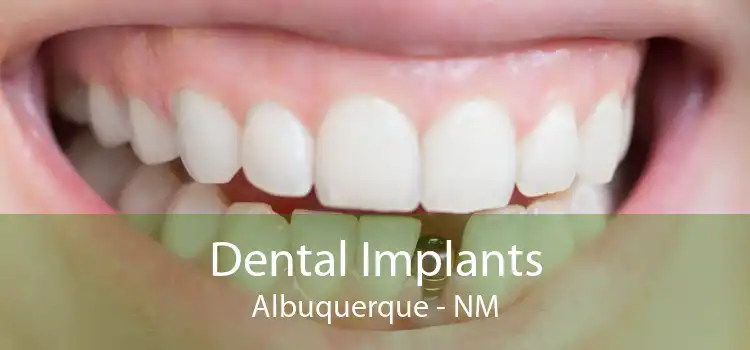 Dental Implants Albuquerque - NM