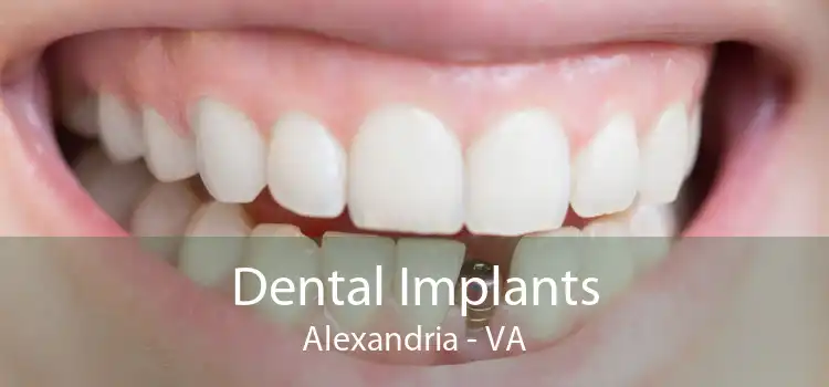 Dental Implants Alexandria - VA
