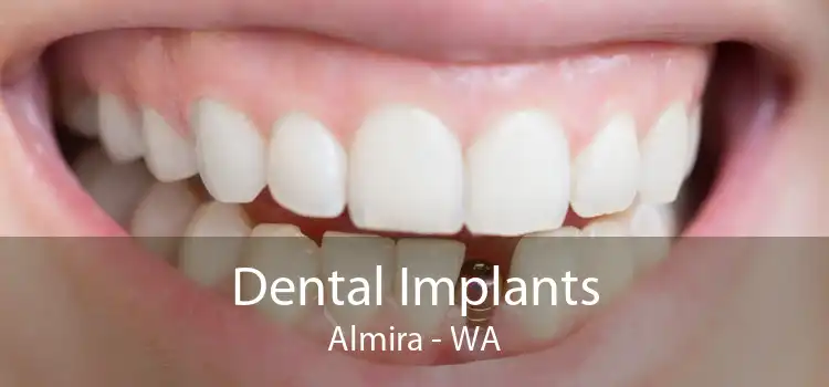 Dental Implants Almira - WA