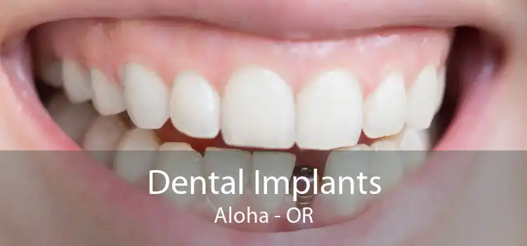 Dental Implants Aloha - OR