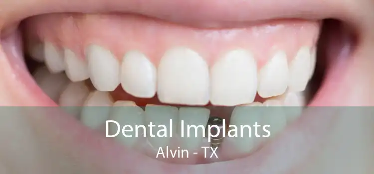 Dental Implants Alvin - TX
