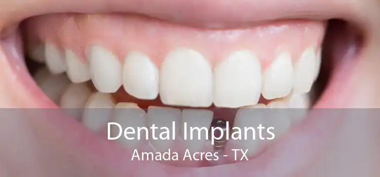Dental Implants Amada Acres - TX