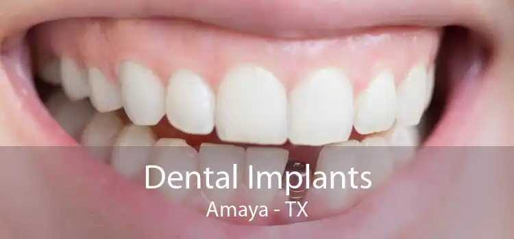 Dental Implants Amaya - TX