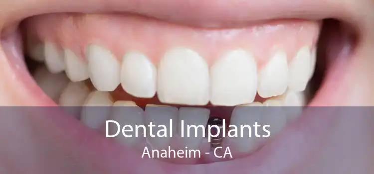 Dental Implants Anaheim - CA