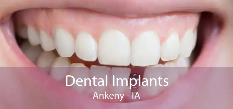 Dental Implants Ankeny - IA