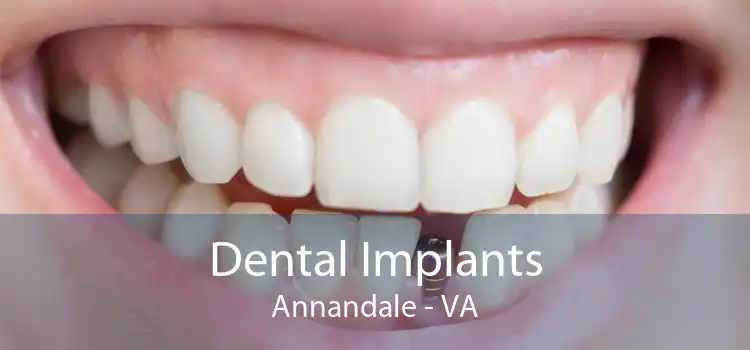 Dental Implants Annandale - VA