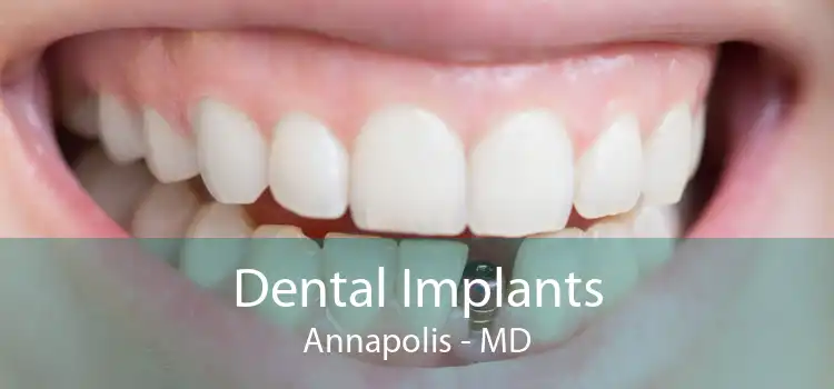Dental Implants Annapolis - MD