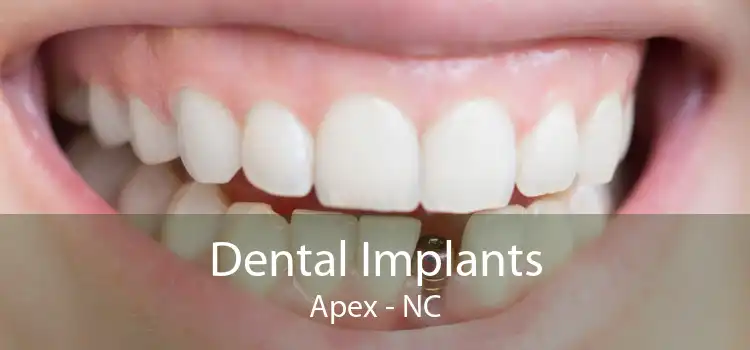 Dental Implants Apex - NC