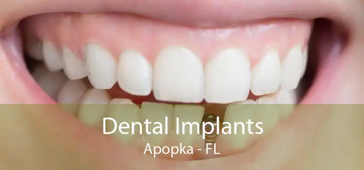 Dental Implants Apopka - FL