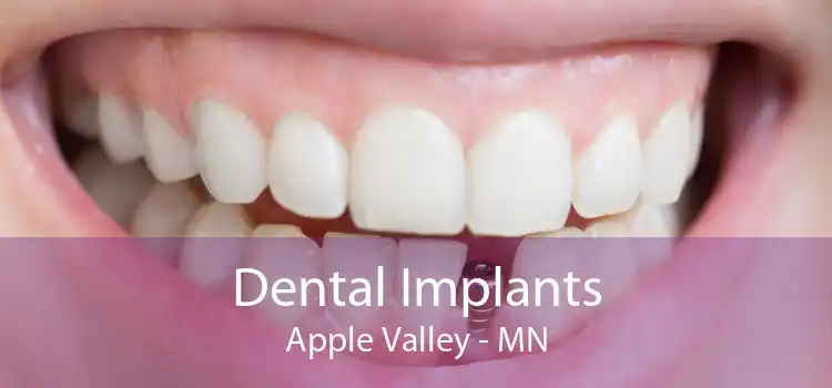 Dental Implants Apple Valley - MN
