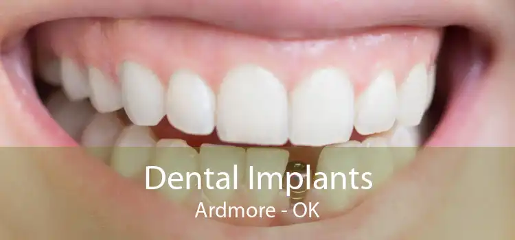 Dental Implants Ardmore - OK