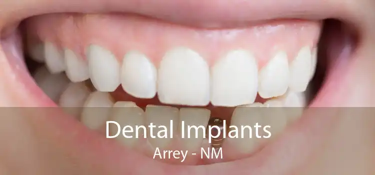 Dental Implants Arrey - NM
