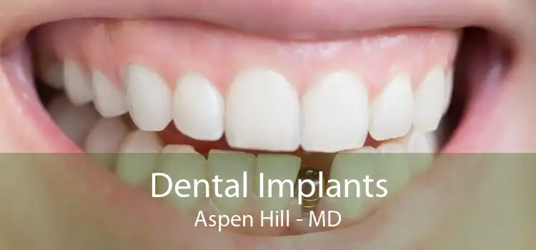 Dental Implants Aspen Hill - MD