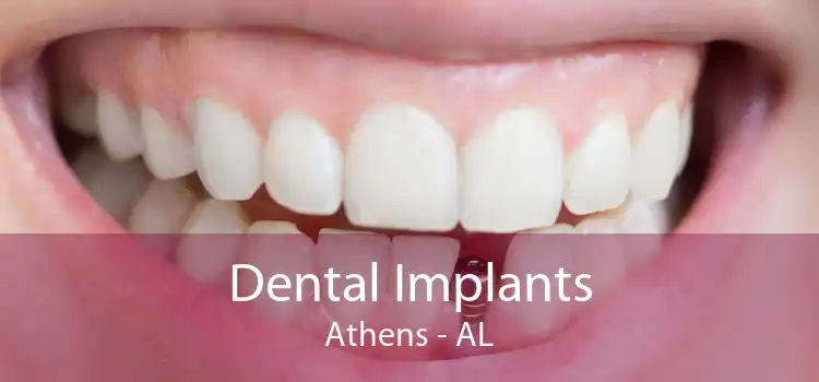 Dental Implants Athens - AL