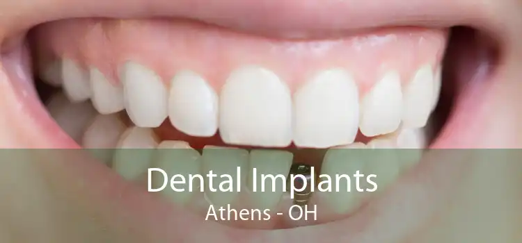 Dental Implants Athens - OH