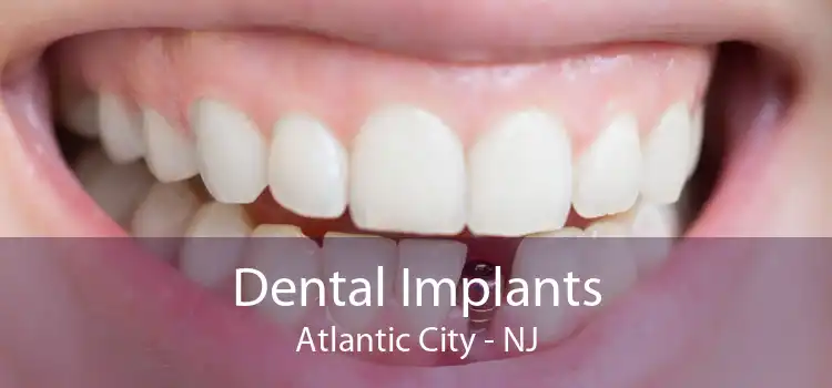 Dental Implants Atlantic City - NJ
