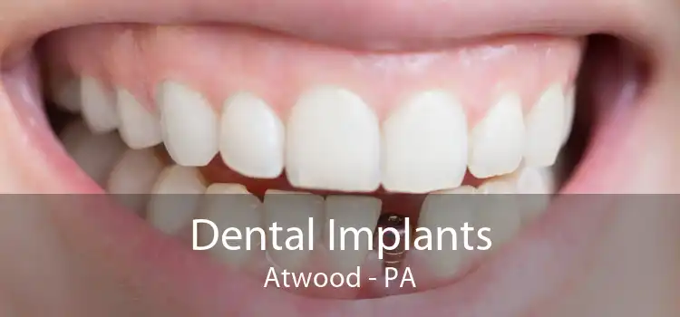 Dental Implants Atwood - PA