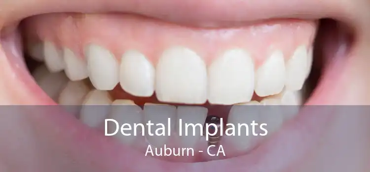 Dental Implants Auburn - CA