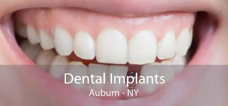 Dental Implants Auburn - NY