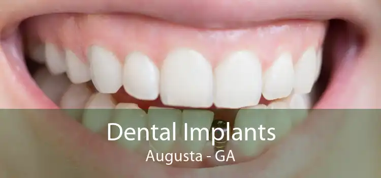 Dental Implants Augusta - GA
