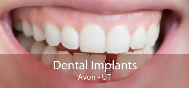 Dental Implants Avon - UT