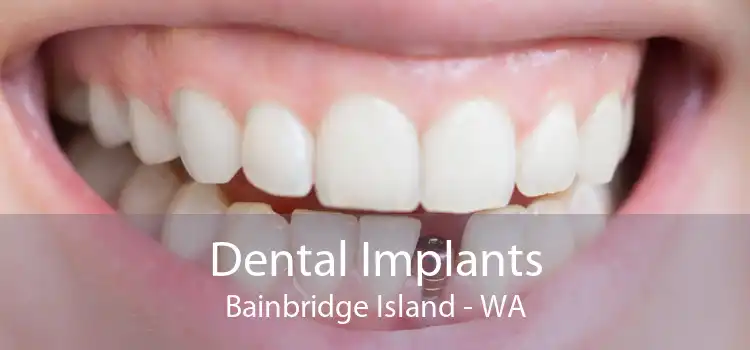 Dental Implants Bainbridge Island - WA