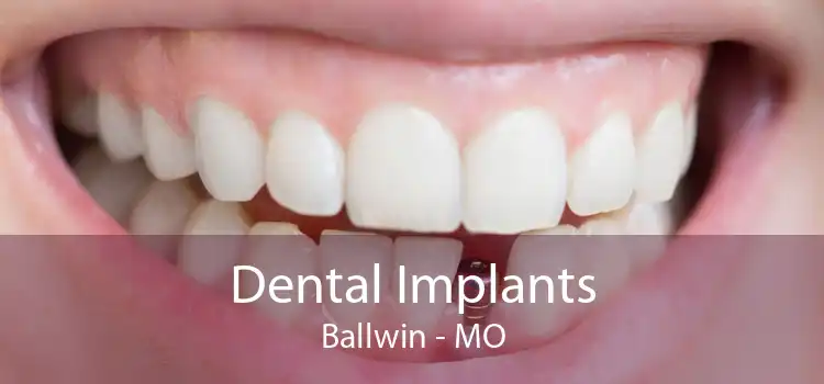 Dental Implants Ballwin - MO