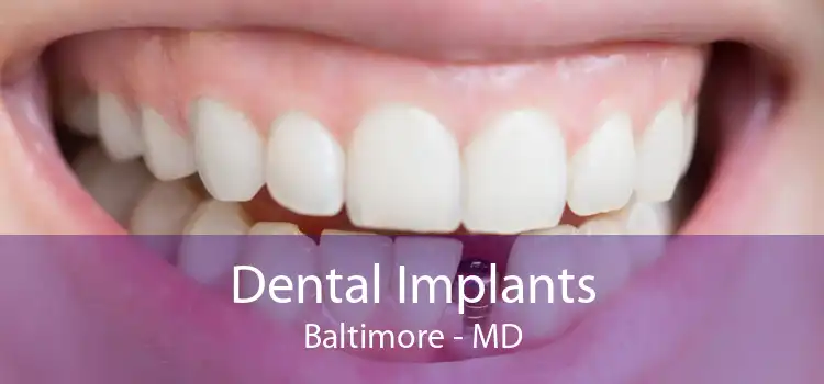Dental Implants Baltimore - MD