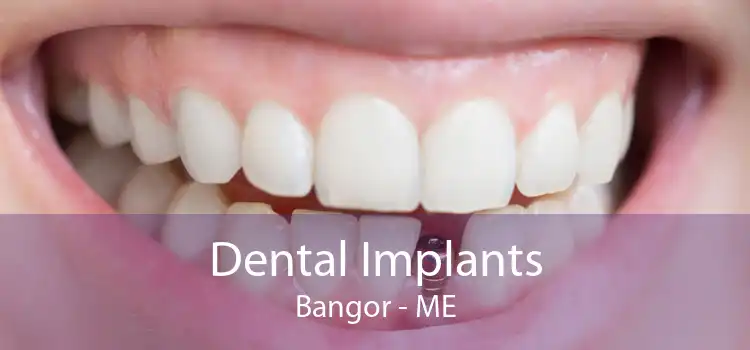 Dental Implants Bangor - ME