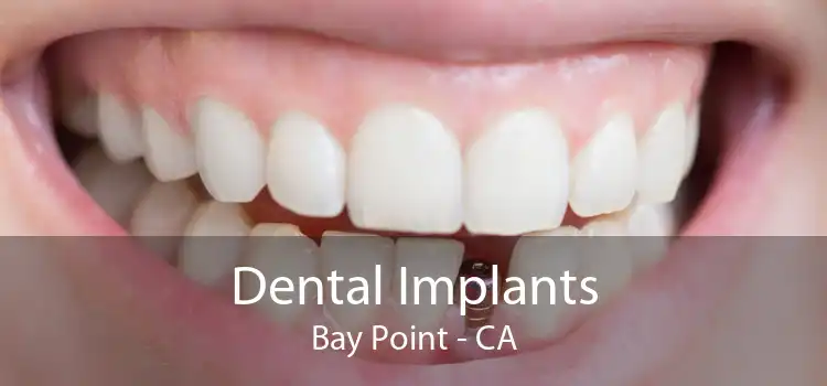 Dental Implants Bay Point - CA