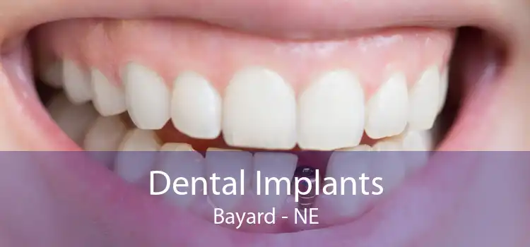 Dental Implants Bayard - NE